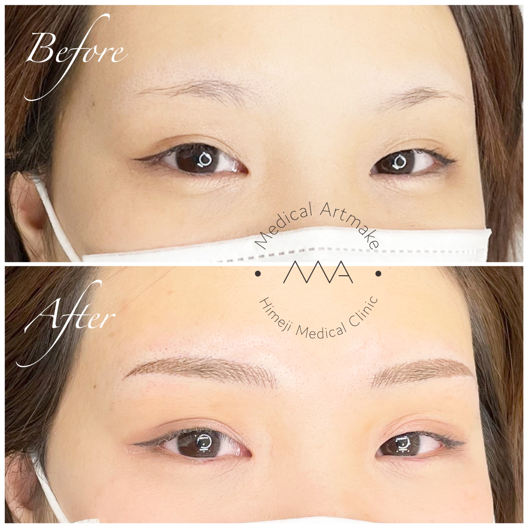 医療アートメイク 姫路で医療脱毛 シミ治療なら 姫路メディカルクリニック 美容皮膚科
