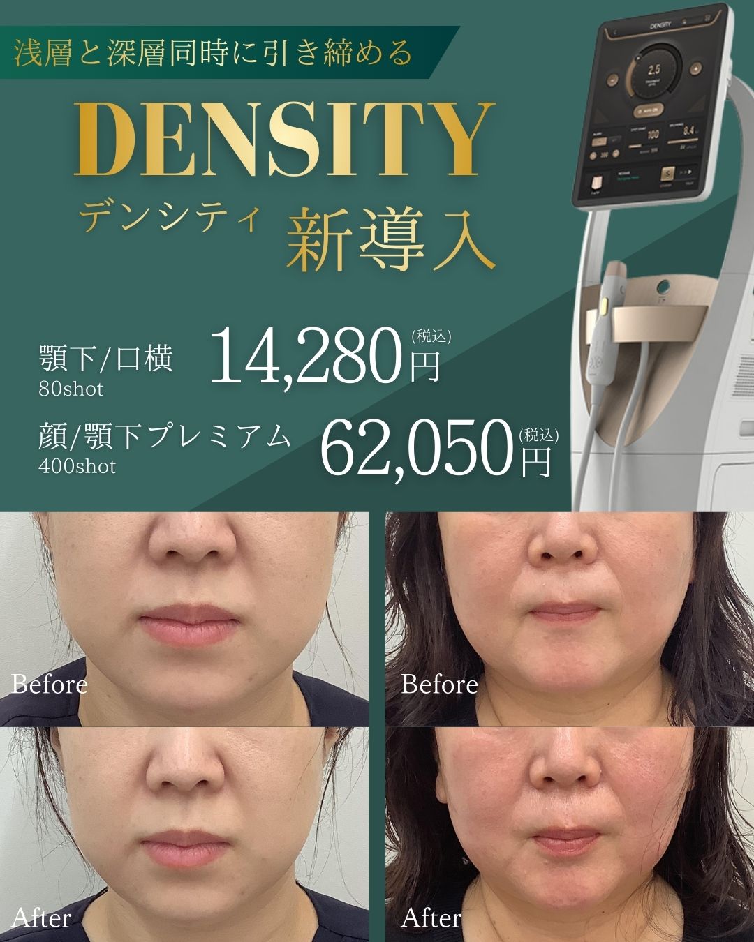 保護中: 【ドクターブログ💗】最新たるみ治療器、導入！！