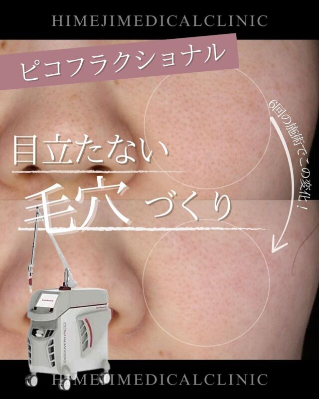 @himeji.mc 美容情報配信中！🌼【ピコフラクショナル】ピコフラクショナルはピコレーザーを使用し、目に見えない程の点状の微細な穴を皮膚に開けます⚡レーザーを当てられた皮膚は肌の再生力によってコラーゲンやエラスチンの生成を促進🍀そのため、肌の深部まで作用し、ニキビ跡、赤み、開いた毛穴などを改善します🌷徐々に新しい皮膚細胞に入れ替わっていきます🌼お問い合わせお待ちしてます♪-———————————🏥姫路メディカルクリニック 📍兵庫県姫路市飾磨区 構2−147🚘姫路バイパス中地IC車3分🅿︎駐車場完備#ピコフラクショナル　#ピコレーザー　#毛穴治療　#毛穴　#ニキビ跡　#姫路メディカルクリニック