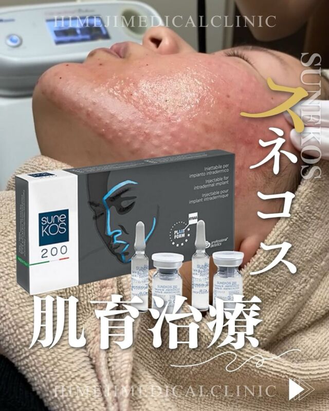 @himeji.mc 肌育治療！💉スネコスとは🤔スネコスとは非架橋の低分子ヒアルロン酸と、6種類のアミノ酸を配合した製剤です🌱◎非架橋ヒアルロン酸→化学物質を含まない柔らかい製剤。注入部位に水分を集めて保湿効果を高める✨◎6種類アミノ酸→線維芽細胞を刺激して、コラーゲンやエラスチンを増生し、ハリや弾力を高める✨当院では水光注射でスネコスを注入することができます🤍ご予約お待ちしております😁-———————————🏥姫路メディカルクリニック 📍兵庫県姫路市飾磨区 構2−147🚘姫路バイパス中地IC車3分🅿︎駐車場完備#スネコス　#スネコス注射　#水光注射　#肌育治療　#肌育注射　#ヒアルロン酸　#アミノ酸　#姫路メディカルクリニック