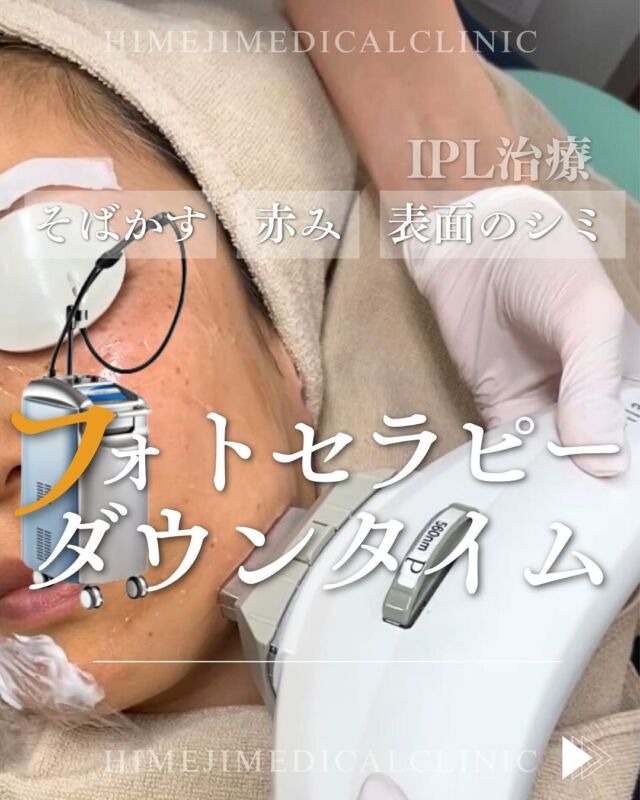@himeji.mc フォトセラピーとは、Intensive Pulse Light（IPL）という高密度の光をお肌に当てることで、シミやくすみ、そばかすのほか、お肌の引き締めや毛穴の開き、赤ら顔、ニキビ跡の改善等さまざまな肌トラブルの改善に効果的な治療です🤩 定期的に繰り返すことでシミやくすみを薄くし、繊維芽細胞が刺激されコラーゲンやヒアルロン酸が増えることで、きめ細かいハリのあるお肌になっていきます🤍 施術直後から通常通りメイクをすることも可能です◎🌟続ける事でさらに効果的!🌟フォトセラピー（光治療）は1回でも効果を実感してもらえますが、1ヶ月おきに5回程度続けて受けていただくことをオススメしています。治療後も継続して行うことがエイジングケアに効果的です💡-———————————🏥姫路メディカルクリニック 📍兵庫県姫路市飾磨区 構2−147🚘姫路バイパス中地IC車3分🅿︎駐車場完備#フォトセラピー　#IPL治療　#光治療　#シミ取り　#ソバカス改善 #赤み改善 #ダウンタイム　#姫路メディカルクリニック